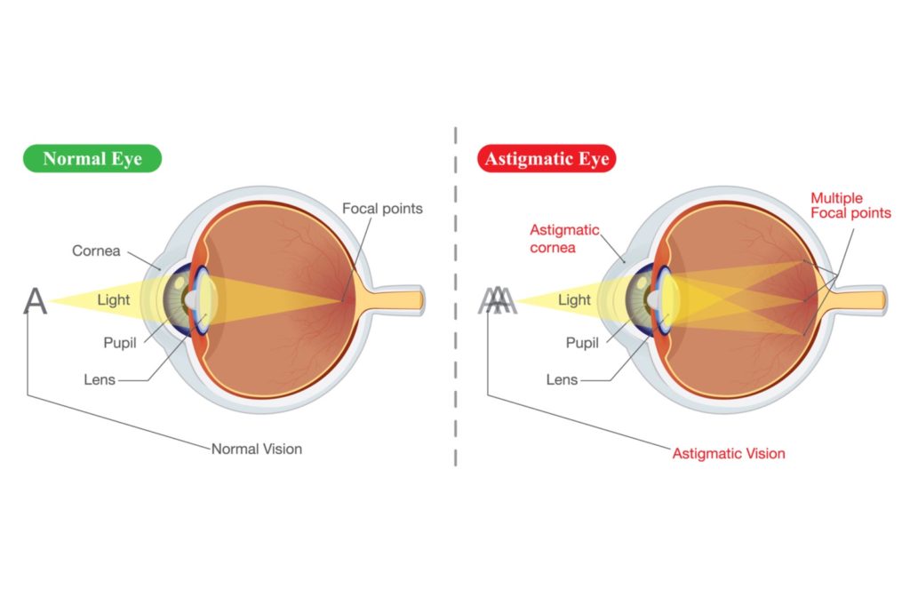 Illustration of normal eye on the left and astigmatic eyes on the right.