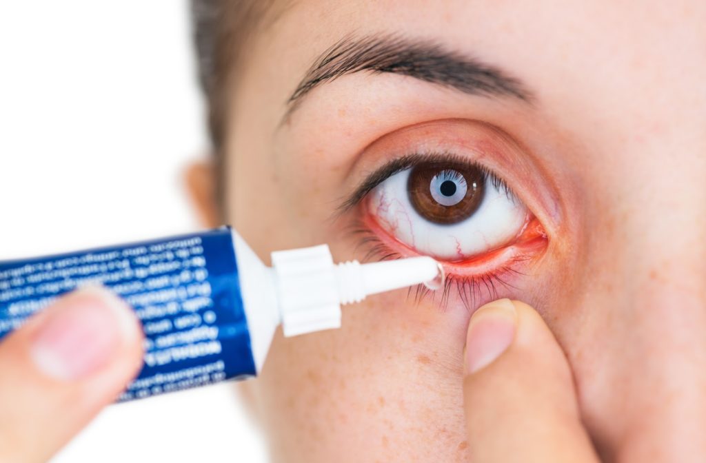 woman applying eye ointment to her right eye as she uses other hand to hold eye down