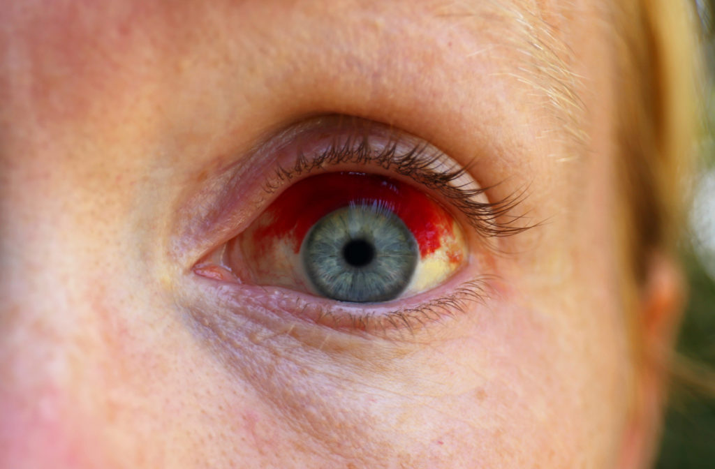 Close up of broken blood vessel in eye needing an examination from optometrist