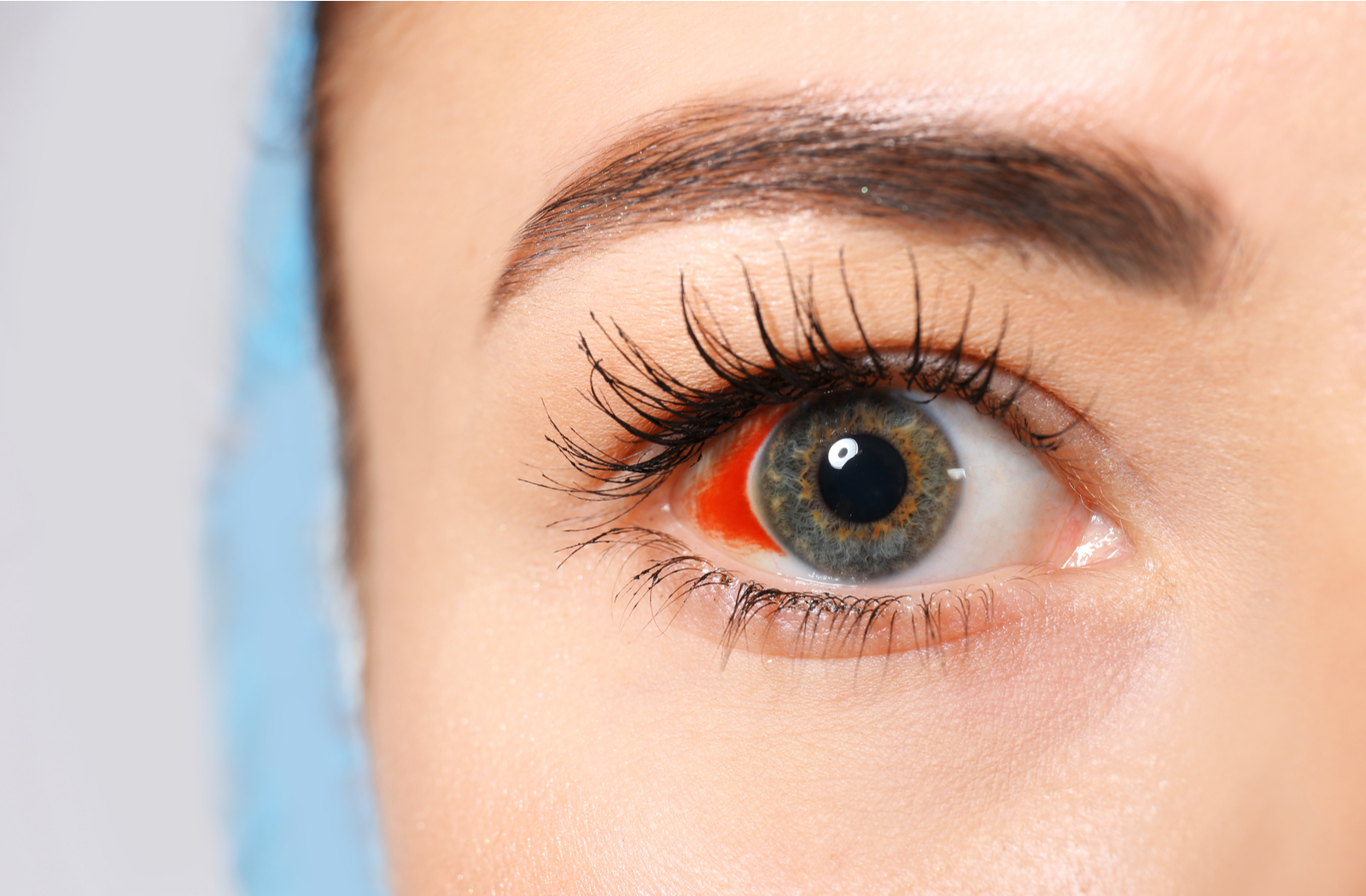 are-broken-blood-vessels-in-your-eye-dangerous-mississauga