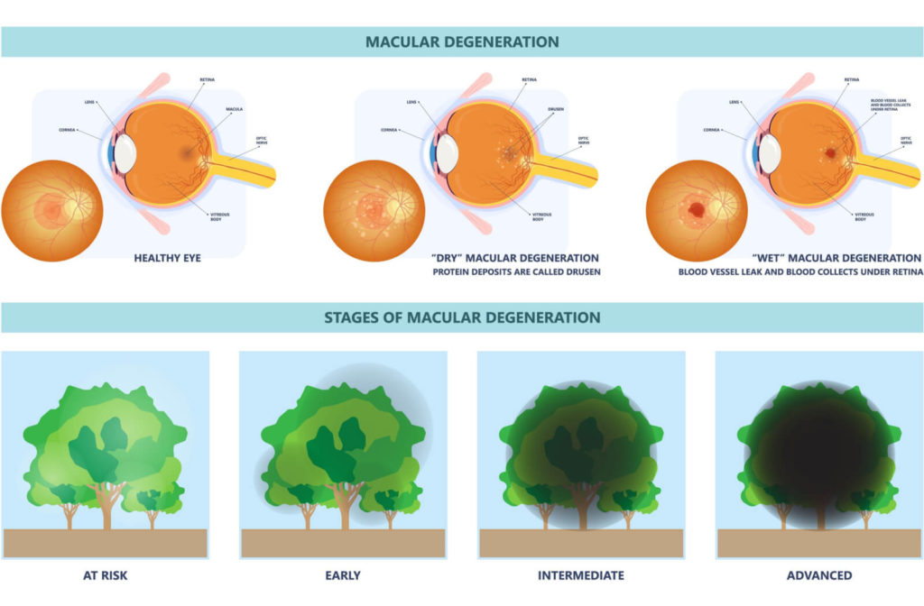 An illustration of stages of macular degeneration. An image of a tree getting blocked by dark shade until it is covered in black.