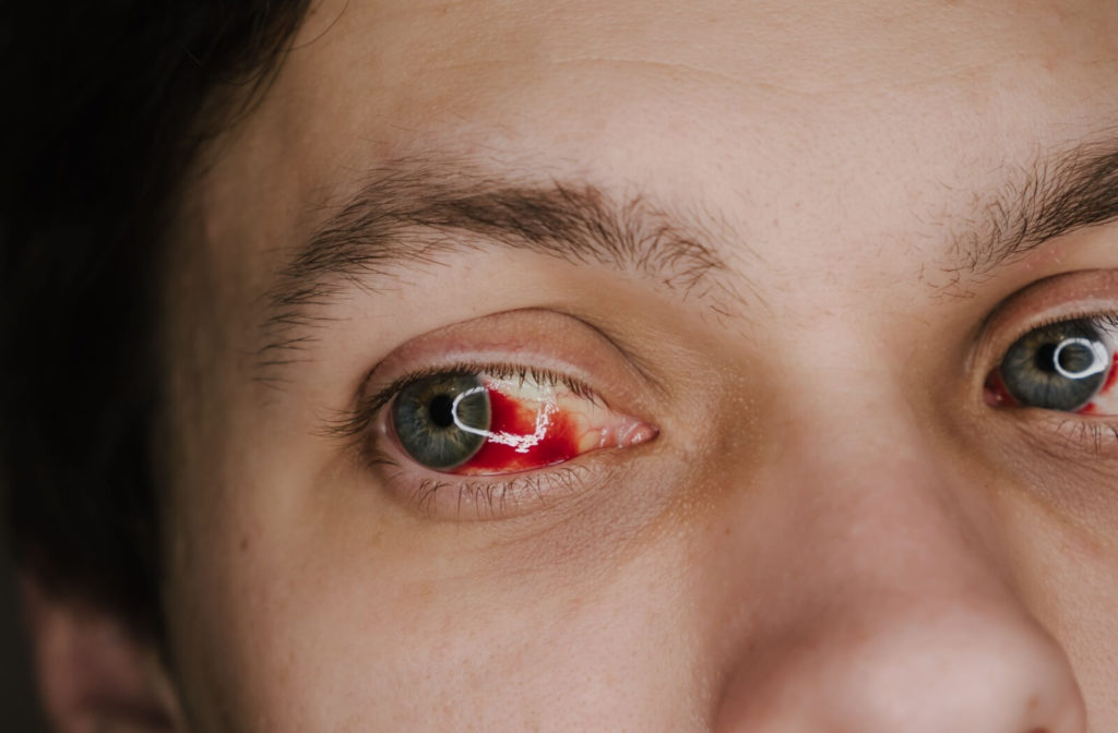 Close-up of an eye with a red spot from a broken blood vessel on the sclera showing the condition clearly