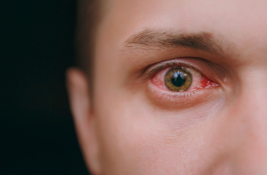 A close-up of a bloodshot eye.