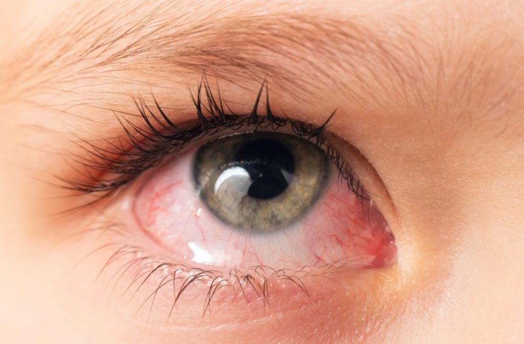 A close up of a woman's eye infected with conjunctivitis.