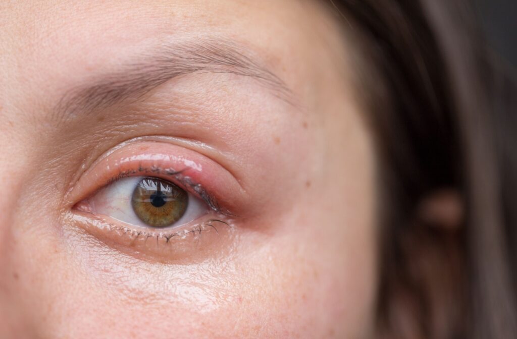 A red eye from blepharitis